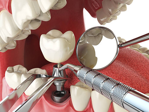 Best Emergency Root Canal Treatment in Hanford, CA